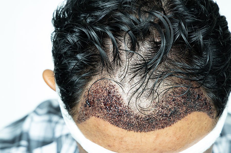 J’ai une cicatrice de FUT : comment la cacher ?