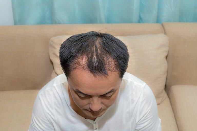 Comment éviter les greffes de cheveux ratées ?