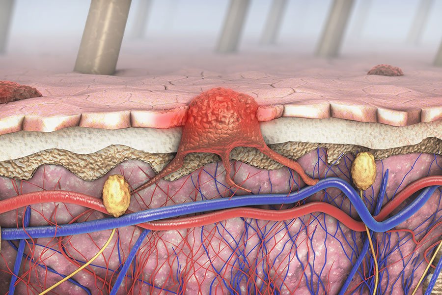 4 astuces pour éviter les poils incarnés
