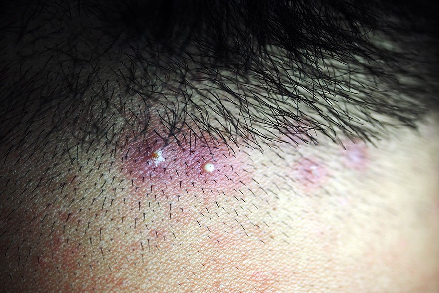 Tout sur les folliculites - Kapich