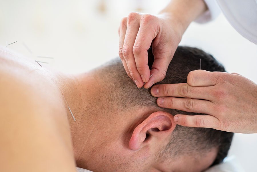 Role de l'accupuncture sur la chute des cheveux